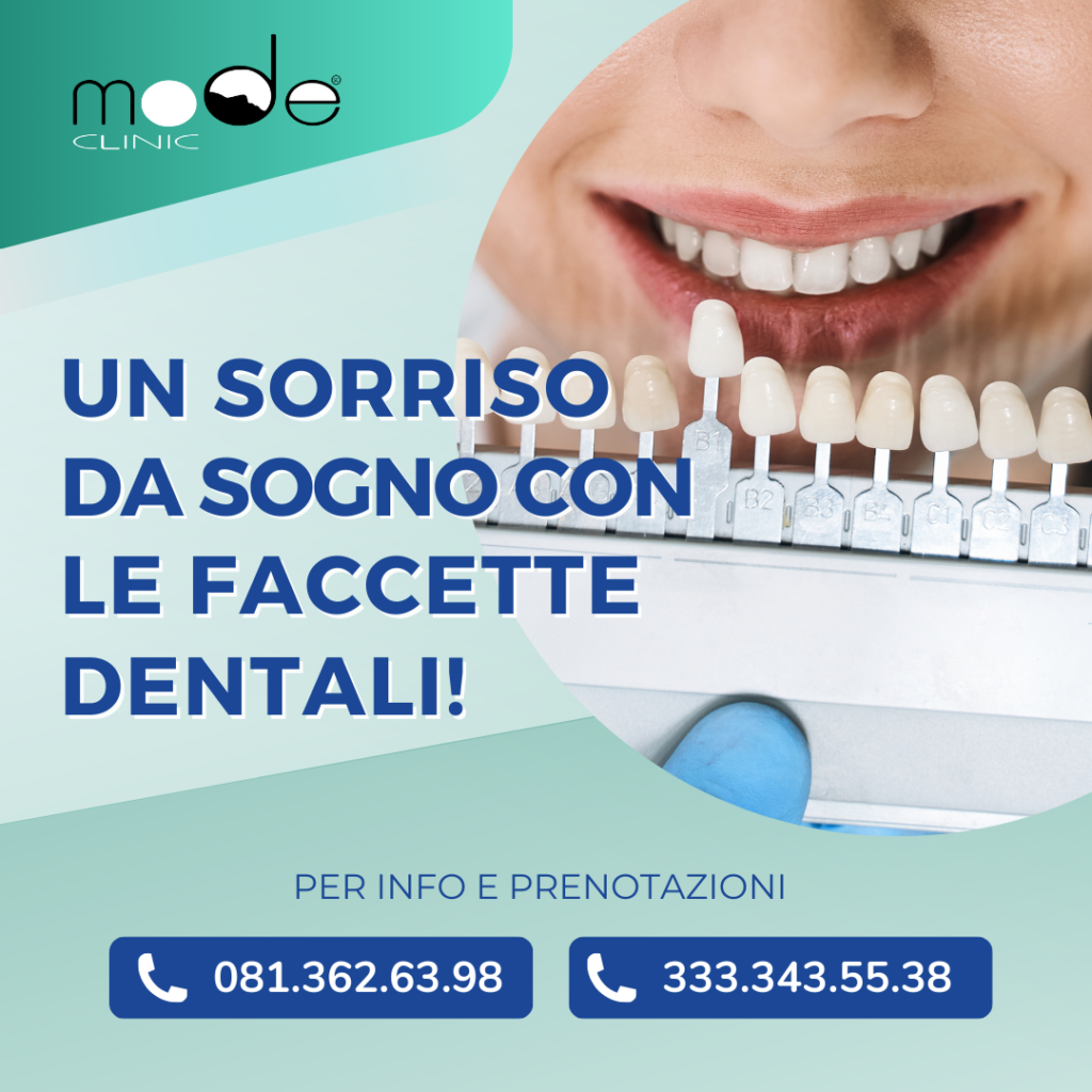 faccette dentali